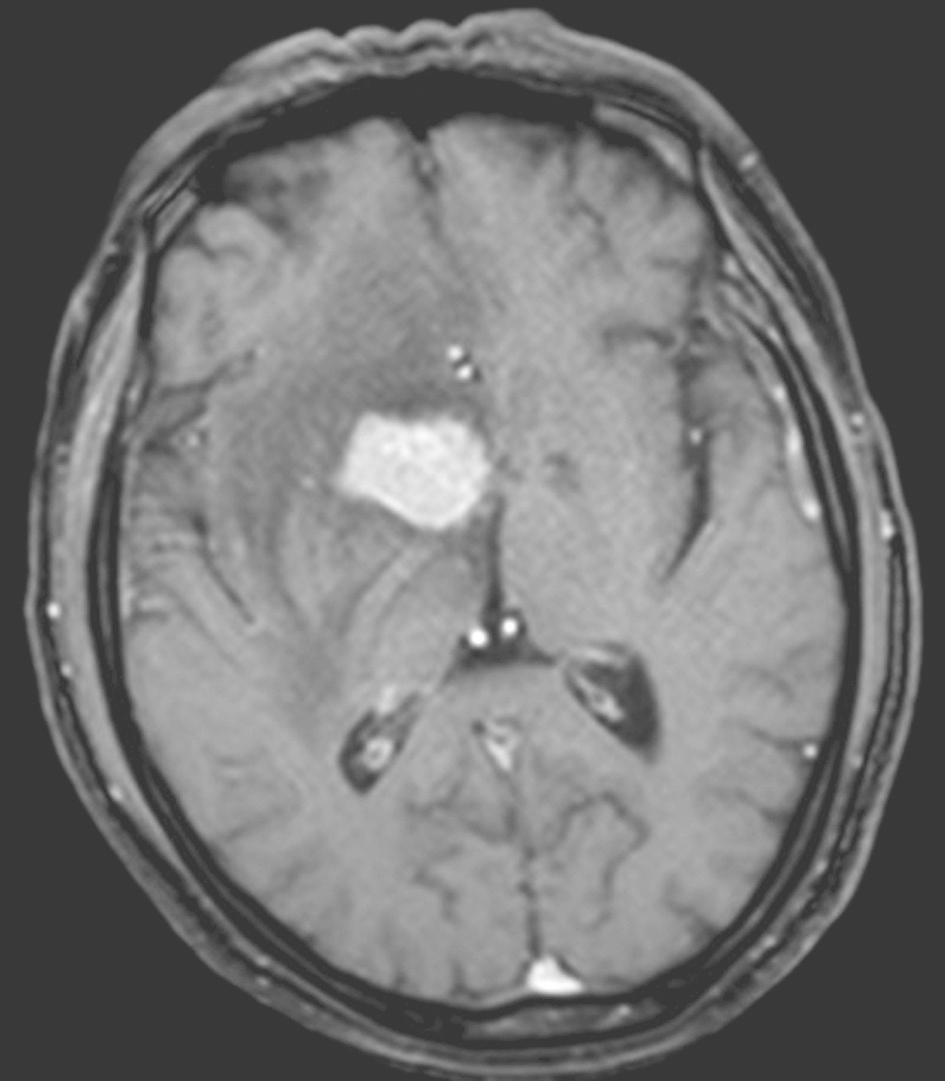 图1 颅脑MRI（2014-07-23）
